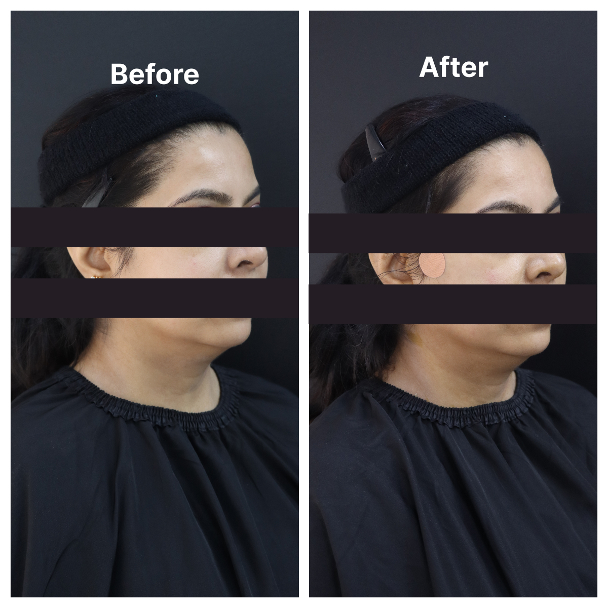 Thread Lift result KOQ10